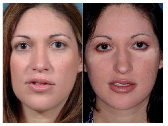 كم تكلفة تجميل الأنف بالخيوط في دبي